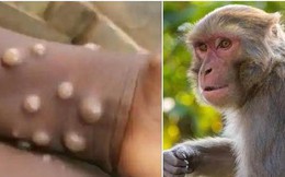 Nóng: Ghi nhận ca bệnh đậu mùa khỉ đầu tiên tại TPHCM