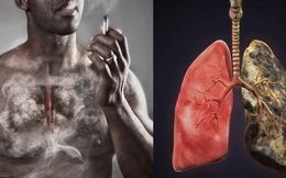 Bệnh viện K hướng dẫn công thức xác định nhóm nguy cơ cao mắc ung thư phổi
