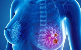Việt Nam mỗi năm có 22.000 ca mắc mới và hơn 9.000 ca tử vong vì ung thư vú: BS Bệnh viện K cảnh báo người dân vẫn coi thường căn bệnh nguy hiểm này