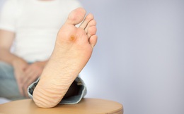 Bác sỹ BV Đại học Y Hà Nội chỉ ra 3 tác nhân dẫn tới những vết loét trên chân của bệnh nhân đái tháo đường