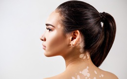 Người có tuổi thọ ngắn, mang bệnh bất thường sẽ có 5 vùng trắng trên cơ thể: Vạch áo soi ngay để phòng ngừa tai hoạ