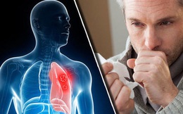 "1 chậm, 2 lồi, 3 thêm" trên cơ thể cảnh báo ung thư phổi: Tưởng bệnh vặt, không thăm khám sớm có thể làm bạn với máy thở cả đời