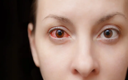 Những bệnh nhiễm trùng mắt liên quan đến COVID