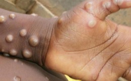 Cần biết: Bộ Y tế khuyến cáo 6 biện pháp phòng chống bệnh đậu mùa khỉ đang 'nóng' tại nhiều quốc gia