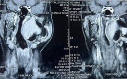 Người đàn ông Bắc Ninh mắc bệnh ung thư cực hiếm gặp: U từ họng 'ăn lan' đến tận sọ