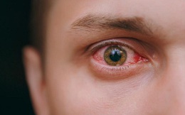 Sai lầm khi sử dụng điều hòa trong mùa hè dẫn đến đột quỵ mắt, nặng nhất có thể gây mù lòa: Chú ý điều này để bảo vệ thị lực và sức khỏe