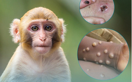 Hướng dẫn cách phân biệt đậu mùa khỉ với thủy đậu, tay chân miệng và Herpes lan tỏa