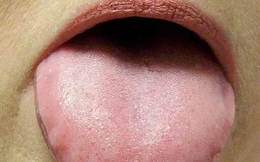 Lưỡi bỗng xuất hiện đốm trắng có thể là dấu hiệu của 3 thứ bệnh, đặc biệt là loại ung thư nguy hiểm này