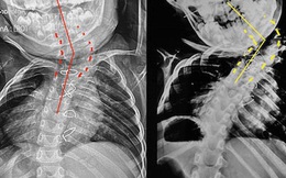 Bé trai 6 tuổi bị biến dạng vẹo lệch cột sống - lời cảnh báo cho các bậc cha mẹ