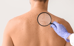 Người đàn ông phát hiện ung thư kịp thời nhờ vợ 'chỉ điểm' 2 dấu hiệu lạ trên lưng