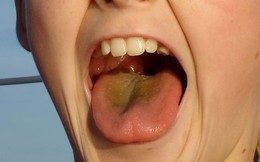 Vàng lưỡi là dấu hiệu cảnh báo những bệnh lý gì?