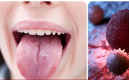 Dấu hiệu ung thư lưỡi giai đoạn đầu