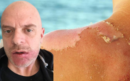 Người đàn ông mắc ung thư da nặng vì 1 thói quen nhiều người mắc vào mùa hè