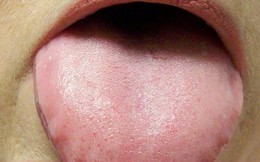 5 dấu hiệu ở lưỡi cảnh báo bệnh ung thư