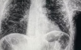Xem ảnh X-quang của bệnh nhân bị ho, bác sĩ phát hiện 'thủ phạm' đáng sợ