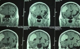 Đi khám đau đầu, phát hiện khối u màng não to hơn quả trứng