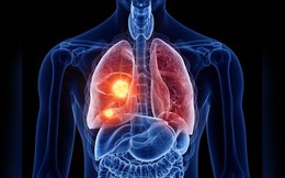 Nghiên cứu ra thuốc chữa ung thư phổi giảm nguy cơ tử vong 51%