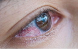 Các biện pháp khắc phục tại nhà cho bệnh đau mắt đỏ