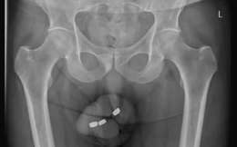 Xem ảnh X-quang của nam bệnh nhân, bác sĩ sốc khi phát hiện dị vật ở chỗ không ngờ