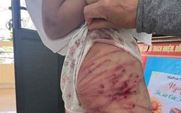 Xác minh thông tin bé gái nghi bị cha dượng bạo hành