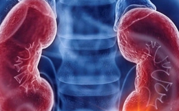 Ung thư thận có chữa khỏi?