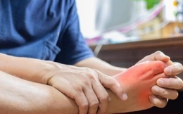 Hai dấu hiệu điển hình của bệnh Chikungunia để phân biệt với sốt xuất huyết