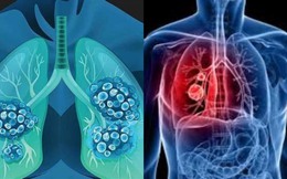 WHO khuyến cáo chỉ cần thay đổi một điều này, nguy cơ UNG THƯ có thể giảm mạnh: Gần 40% ca bệnh hoàn toàn có thể phòng tránh