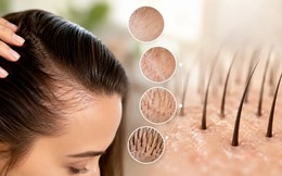 Cơn sốt Minoxidil: Giải pháp khoa học cứu cánh cho mái tóc thưa