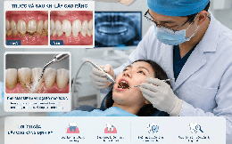 Vì sao lấy cao răng không làm mòn răng? Giải mã một trong những hiểu lầm lớn nhất về chăm sóc răng miệng