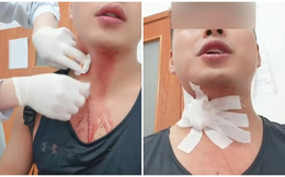Khó tin: Nhập viện do vỡ tĩnh mạch sau khi cố đập... muỗi