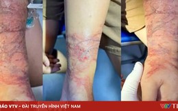 Cảnh giác sứa đốt khi tắm biển