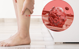 Bất kể giới tính, nếu điều này xuất hiện trên chân, đó có thể là dấu hiệu của cục máu đông trong cơ thể