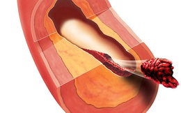 5 căn bệnh phổ biến khiến nam giới ở độ tuổi trẻ đột tử