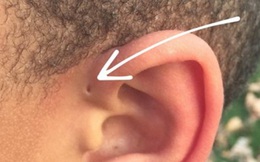Chỉ 2% dân số có cái lỗ kỳ lạ và không kém phần nguy hiểm này trên tai