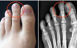 Ngón chân trỏ dài hơn ngón chân cái và cái kết chỉ 15% dân số thế giới phải chịu