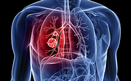Dấu hiệu cảnh báo ung thư phổi đang “sống” trong cơ thể: Nhận biết sớm cơ hội sống lên tới 55%
