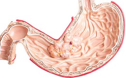Đau dạ dày làm sao để bệnh không nặng hơn? Đây là giải pháp đầu tiên bạn nên thực hiện