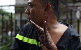 Hình ảnh anh lính cứu hỏa bị bỏng tuột da tay khi tham gia chữa cháy, cứu hộ tại chung cư Carina khiến nhiều người xót xa