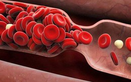 6 dấu hiệu cảnh báo cục máu đông: Nhiều người nhầm lẫn nên gặp nguy hiểm, thậm chí tử vong