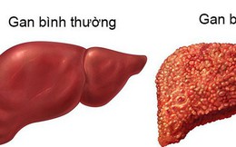 Xơ gan có thể dẫn đến ung thư gan: Đây là 4 nguyên tắc quan trọng giúp phòng ngừa hiệu quả