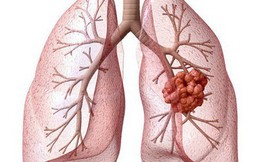 Ung thư phổi gây tử vong số 1: Những dấu hiệu cảnh báo sớm tuyệt đối không nên "lờ đi"