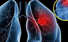 Tưởng viêm phổi lại hoá ung thư giai đoạn 4, người phụ nữ cảnh báo về 1 dấu hiệu cần chú ý