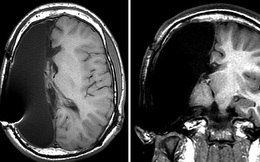 Phải cắt bỏ một nửa bộ não từ khi còn bé, những đứa trẻ này vẫn lớn lên, đi học, đi làm và thành đạt