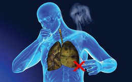 Cảnh báo: Người hút đến 2 bao thuốc mỗi ngày, hoặc liên tục tiếp xúc với khói thuốc phải xét nghiệm ung thư phổi ngay trước khi quá muộn