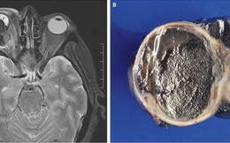 Tròng mắt cũng có thể bị ung thư và những gì xảy đến sau đó sẽ khiến bạn giật mình