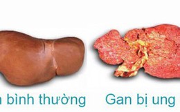 Chỉ đứng sau Mông Cổ và Lào, căn bệnh ung thư này đang hoành hành ở Việt Nam