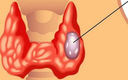 16 tuổi ung thư tuyến giáp - Bác sĩ ung thư nói gì?