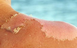 Chuyên gia da liễu hướng dẫn cách chống nắng hoàn hảo khi đi biển, ngăn chặn cháy nắng, bỏng nắng và cả ung thư da