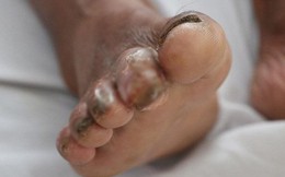 Người đàn ông ở Hà Tĩnh bị vi khuẩn "ăn thịt người" tấn công ngón chân