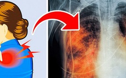 5 dấu hiệu của bệnh ung thư phổi nhiều người thường bỏ qua